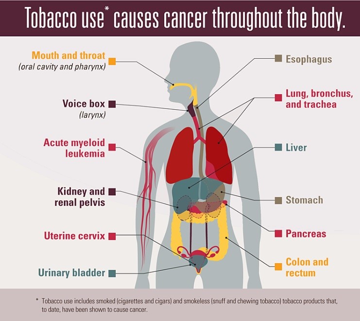 Tobacco use causes cancer throughout the body